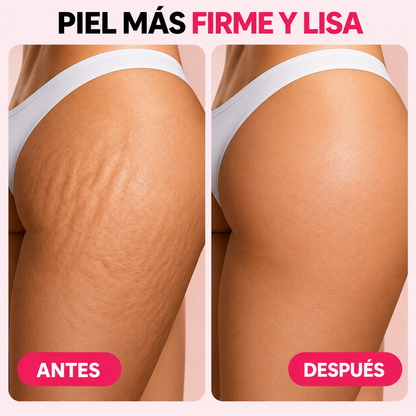 Crema Reductora de Estrías y celulitis